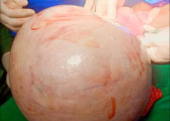 Médica gineco-obstetra do HCN remove tumor gigante do ovário de uma paciente com mais de 10 quilos