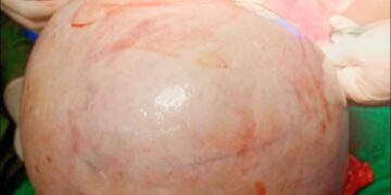 Médica gineco-obstetra do HCN remove tumor gigante do ovário de uma paciente com mais de 10 quilos